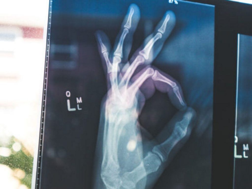An x-ray giving the "okay" sign with their hand Osteoporosis